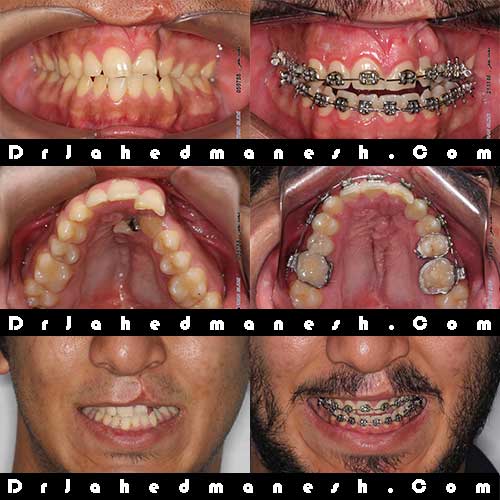 انجام ارتودنسی ثابت